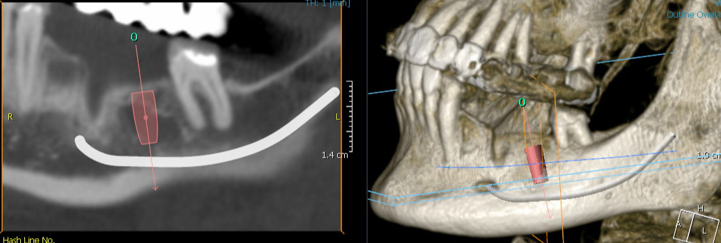 3- dimensionale, digitale Diagnostik unterstützt bei der Planung, der Auswahl eines geeigneten Implantat-Designs und der optimalen Implantat-Position