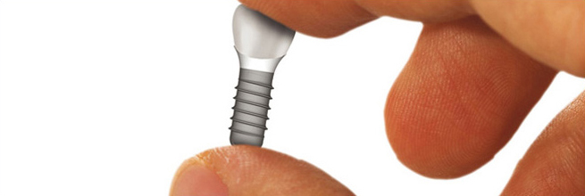 Implantate ermöglichen die optimale Wiederherstellung Ihrer natürlichen Gebissverhältnisse