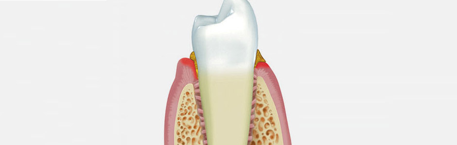 Durch sorgfältige und kontinuierliche Verbesserung der häuslichen Zahnpflege kann die Gingivitis abheilen. 