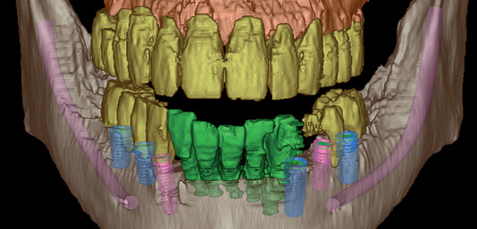 Mit den gestochen scharfen 3-D-Ansichten können ausgesuchte, einzelne Segmente oder komplexe Zusammenhänge der knöchernen Strukturen des Oberkiefers und des Unterkiefers detailliert dargestellt werden