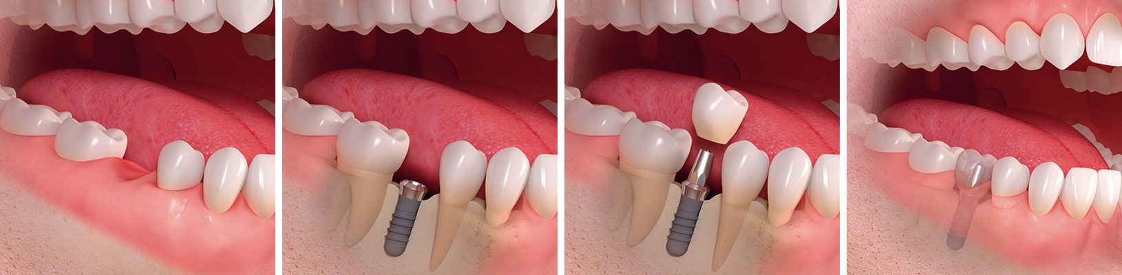 Ablauf der Implantatinsertion