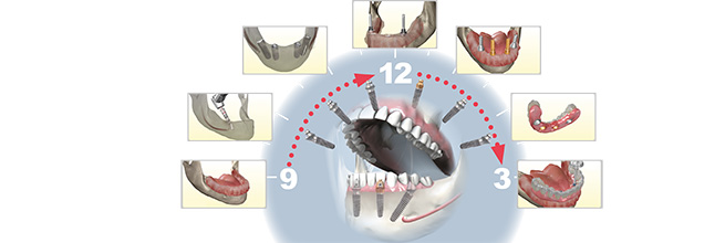 Minimal invasive Implantation und Sofortversworung am Tag der Operation. Feste Zähne an einem Tag sind möglich.